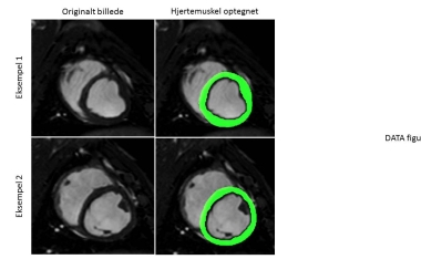 Kunstig intelligens til automatiseret hjerteanalyse ud fra magnetisk r...
