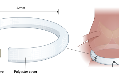 AorticPhlex Annuloplasty