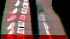 Dosis nedsættelse til normalt væv fra daglig CBCT under et strålebehandlingsforløb til unge cancerpatienter